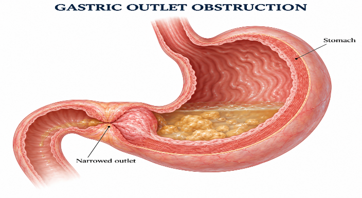 Gastric outlet obstruction